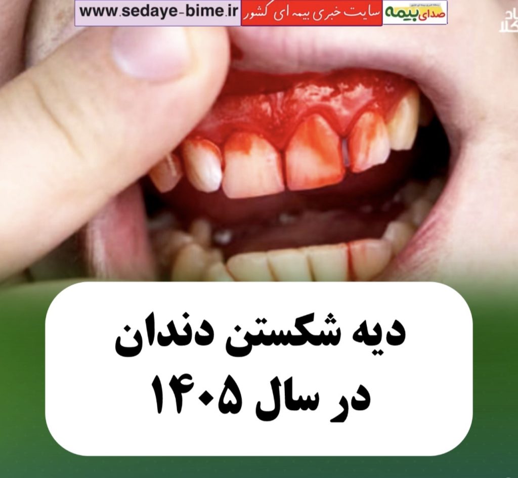 دیه شکستن دندان در سال 1405، صدای بیمه، خبرگزاری بیمه، سایت خبری بیمه، سایت صدای بیمه،