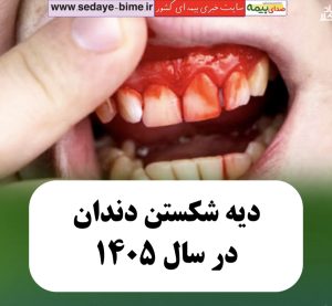 دیه شکستن دندان در سال 1405، صدای بیمه، خبرگزاری بیمه، سایت خبری بیمه، سایت صدای بیمه،