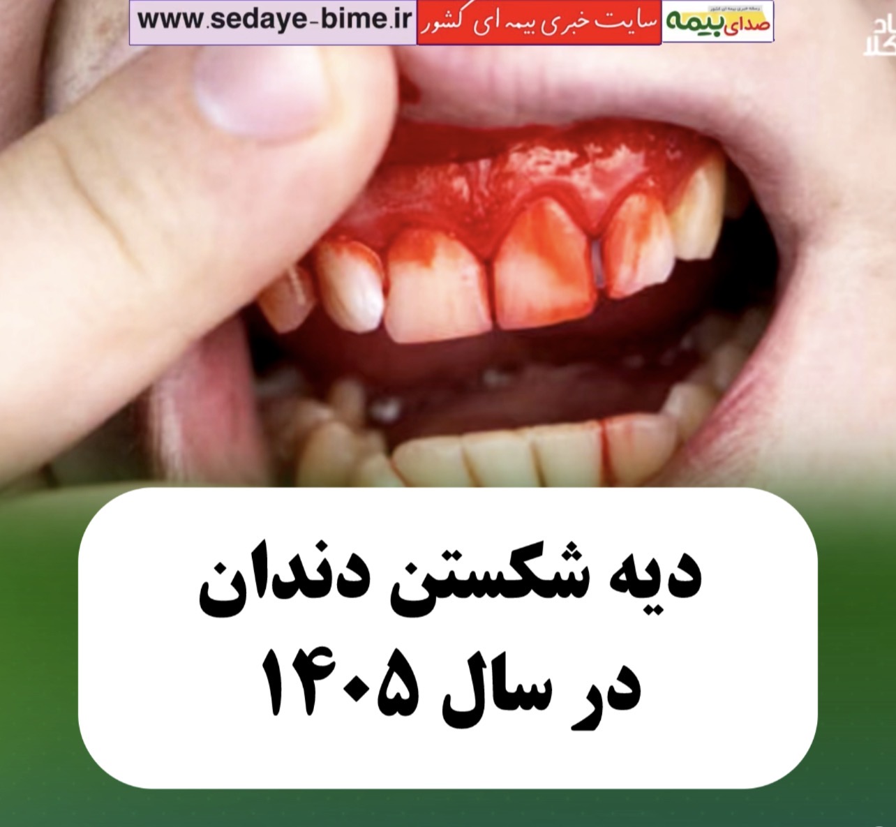 دیه شکستن دندان در سال 1405، صدای بیمه، خبرگزاری بیمه، سایت خبری بیمه، سایت صدای بیمه،